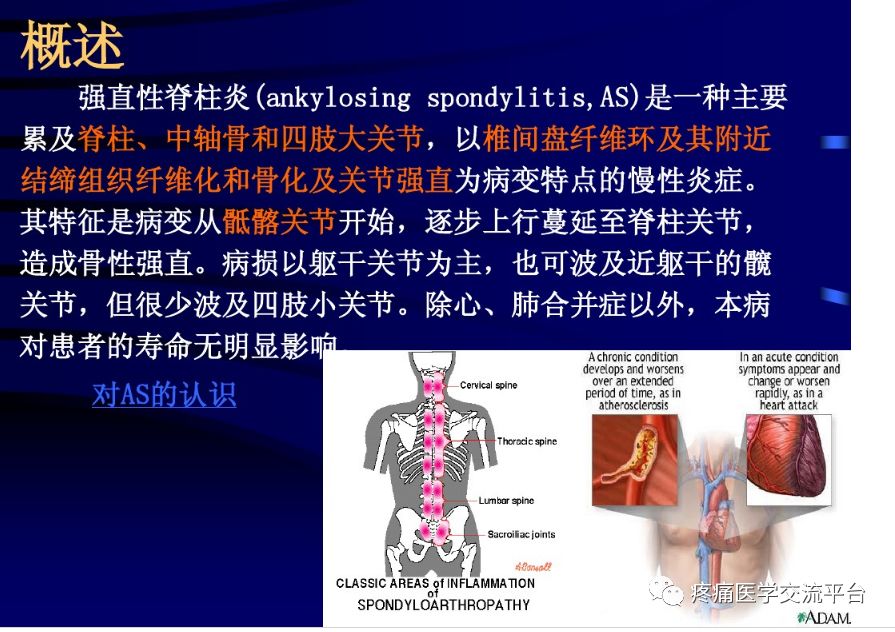 强直性脊柱炎最新疗法,强直性脊柱炎最新疗法，突破传统，走向新生