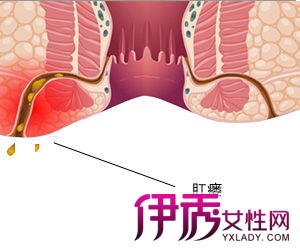 肛瘘的最新治疗方法,肛瘘的最新治疗方法