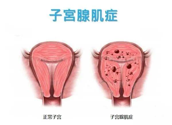 子宫腺肌症最新治疗,子宫腺肌症最新治疗进展与策略